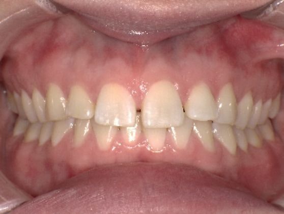 A smile with crooked teeth and a slight gap in the front incisors