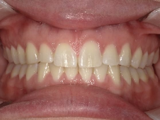 The same smile after using Invisalign aligners the teeth are straighter and have no gap.