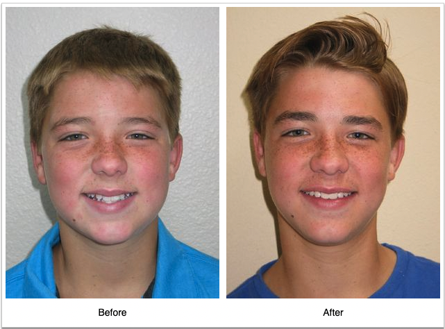 Orthodontics before and after photo