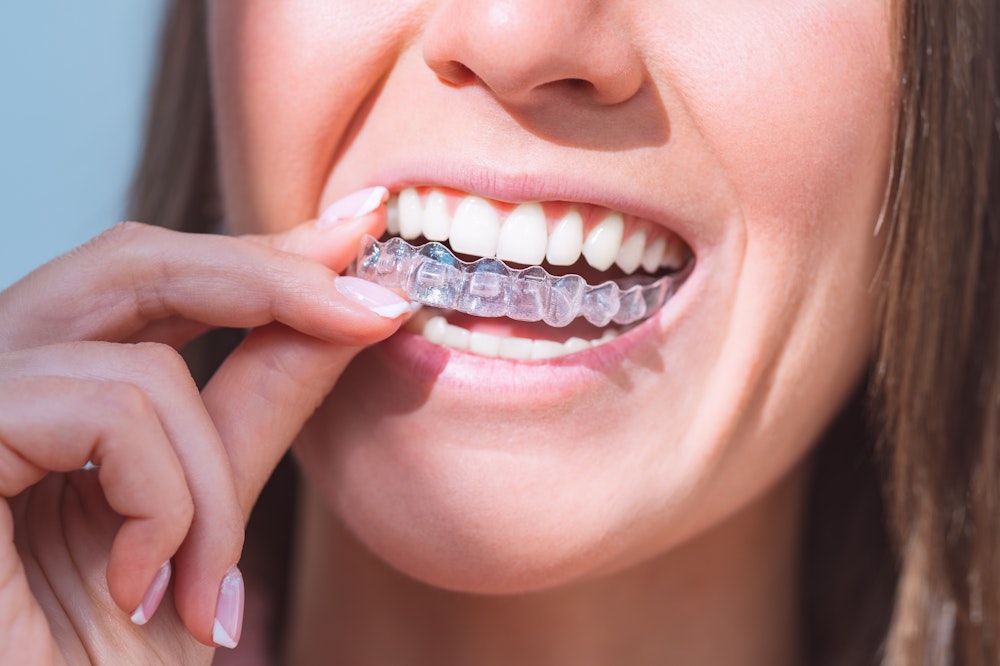 close up of young girl placing her invisalign aligner