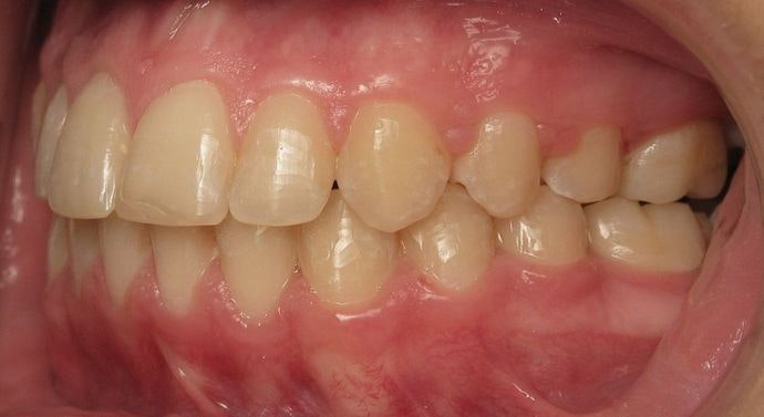 Hulme Orthodontics Patient After Treatment With Braces