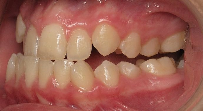 Hulme Orthodontics Patient Before Treatment With Braces