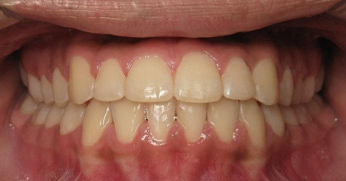 Case 1 after underbite treatment