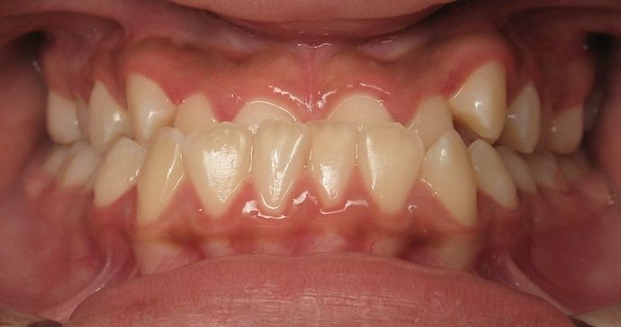 Case 1 before underbite treatment