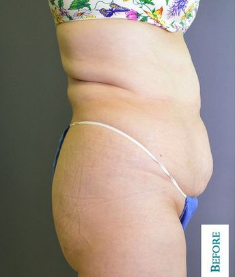 our San Antonio patient before bbl