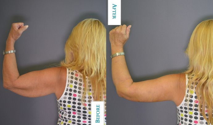 Dr. Bernard Kopchinski's Patient Before Liposuction