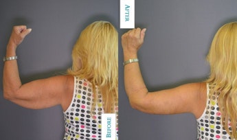 Dr. Bernard Kopchinski's Patient Before Liposuction