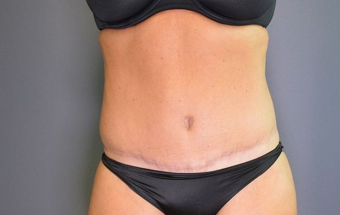 After tummy tuck