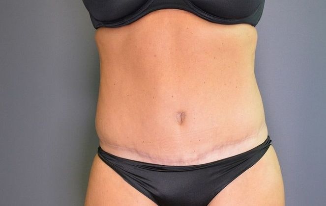 After tummy tuck