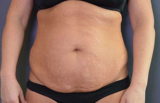 Before tummy tuck