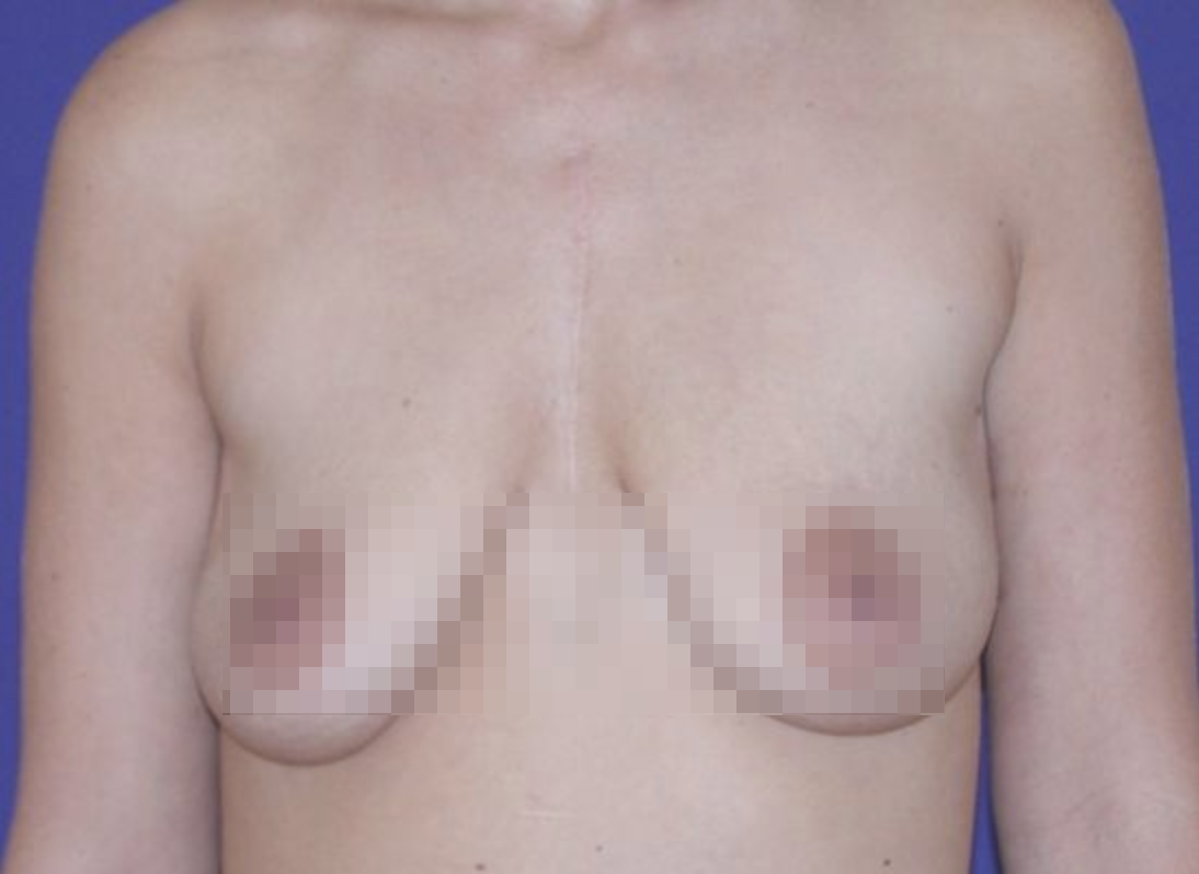 Breasts before Breast Augmentation