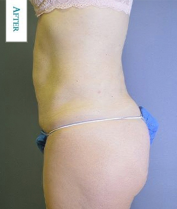 Dr. Bernard Kopchinski's Patient After Liposuction