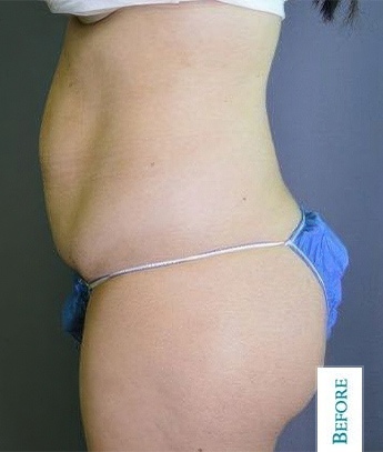 Dr. Bernard Kopchinski's Patient Before Liposuction