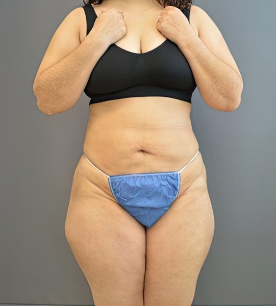 Dr. Bernard Kopchinski's Patient After Liposuction