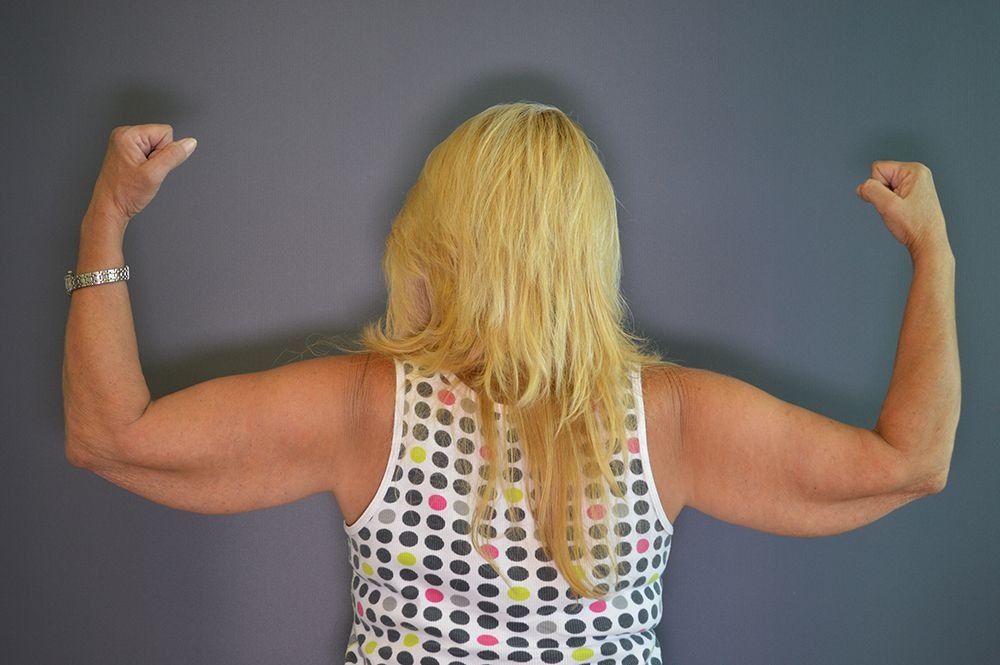 Dr. Bernard Kopchinski's patient before arm lift