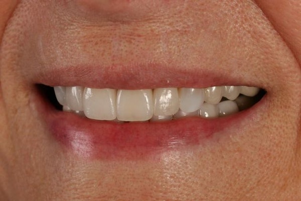 after veneers