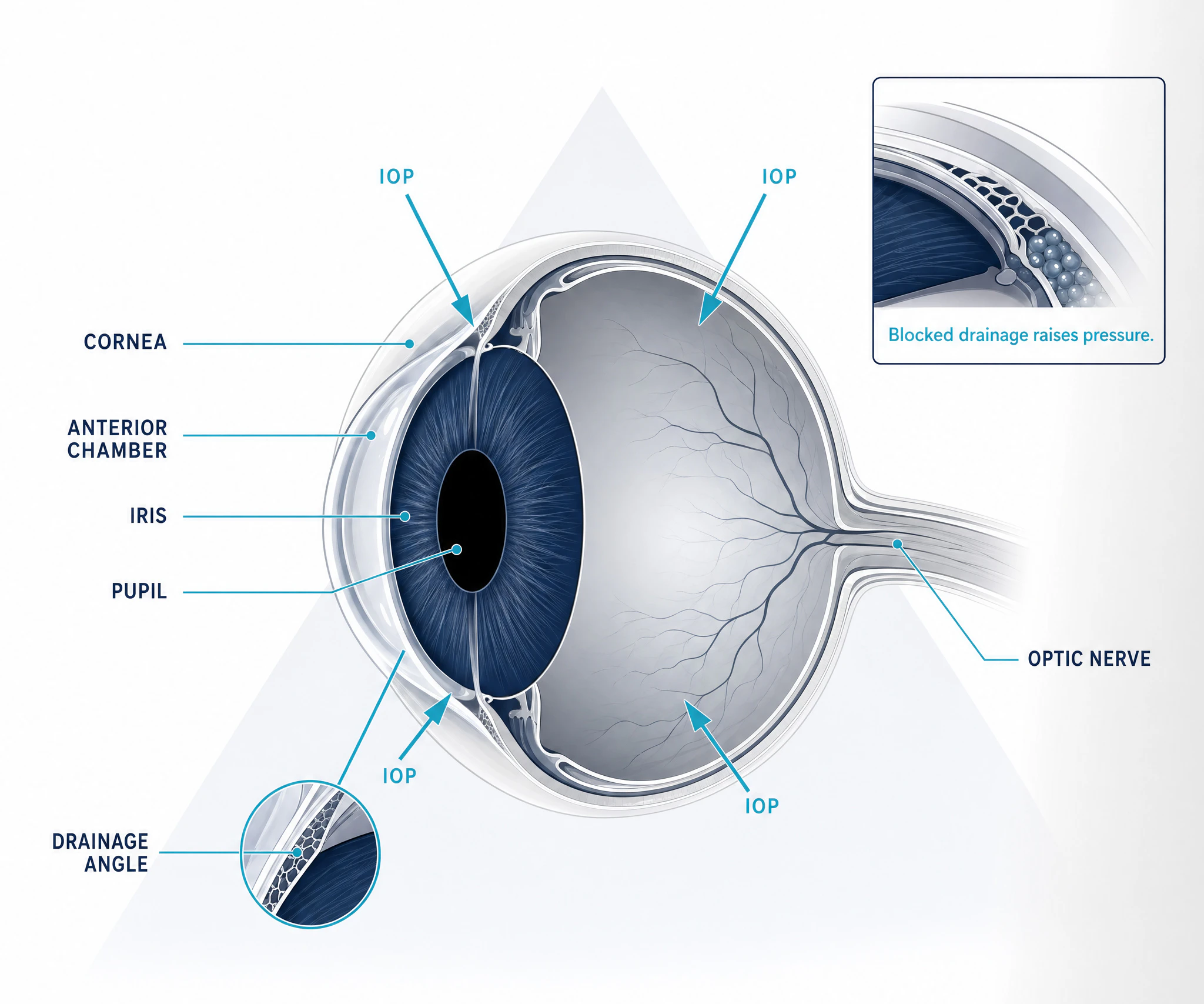 eye with glaucoma diagram