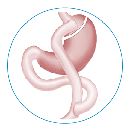 gastric bypass surgery in Mexico