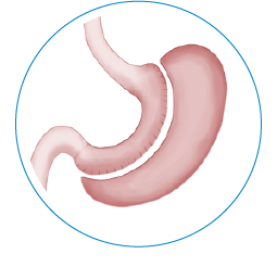 gastric sleeve mexico