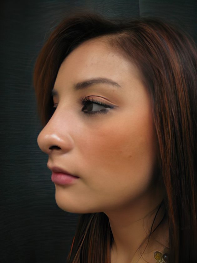 Case 2 after rhinoplasty