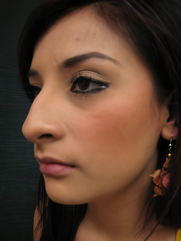 Case 2 before rhinoplasty