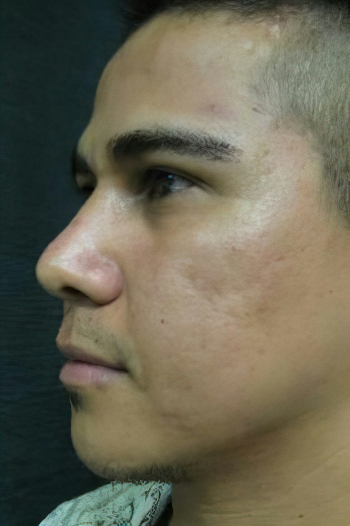 Case 1 after Rhinoplasty