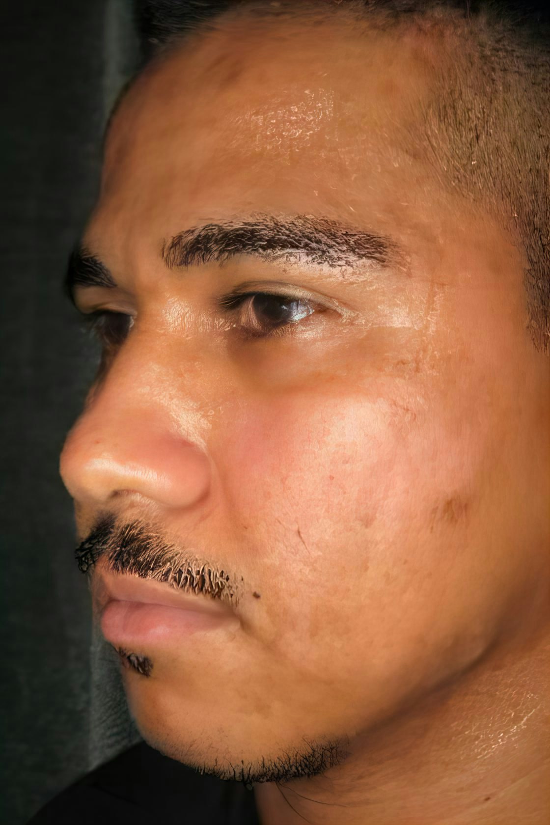 Case 1 before Rhinoplasty