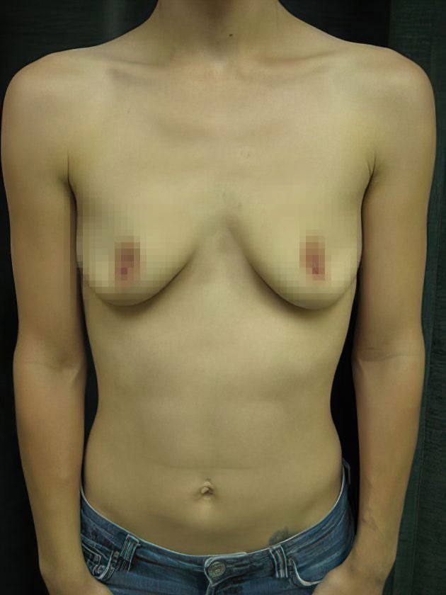 Case 2 Before TUBA Breast Augmentation