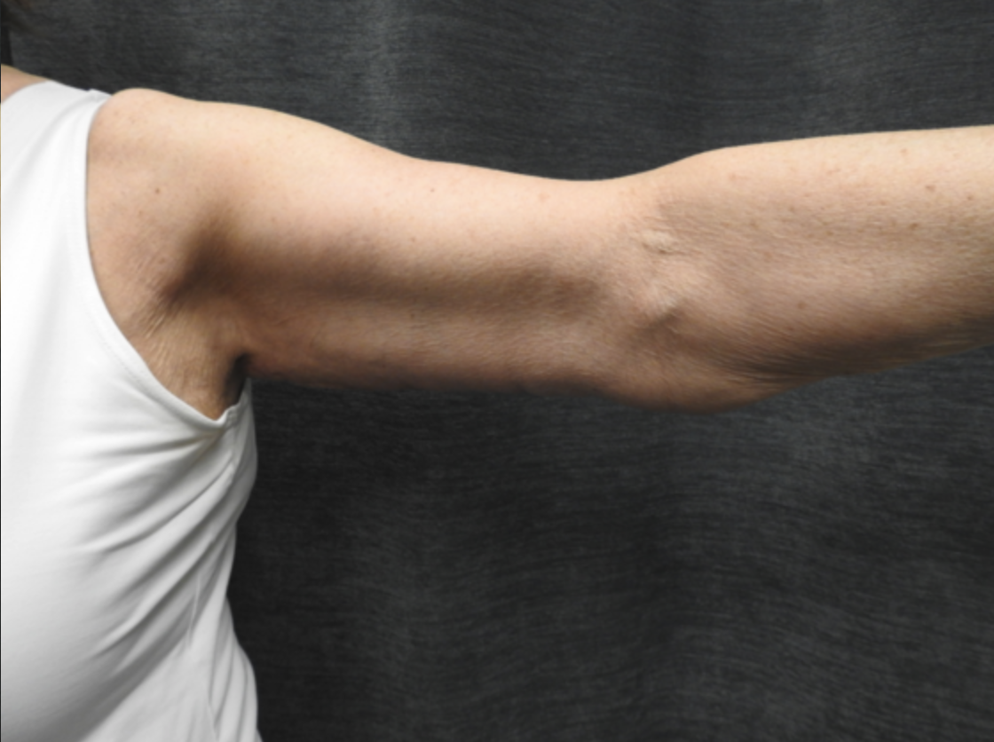 Get Rid of Flabby Arms With an Arm Lift in Lubbock