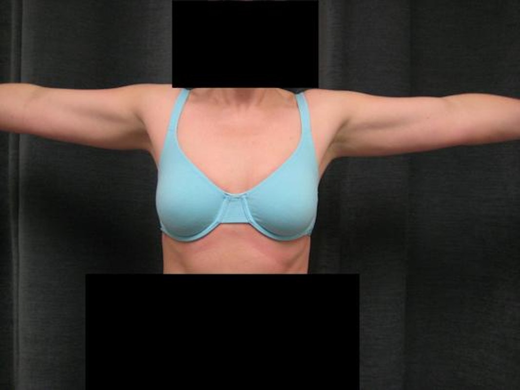 Dr. Constance Barone's patient after liposuction