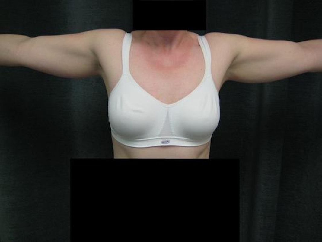 Dr. Constance Barone's patient before liposuction