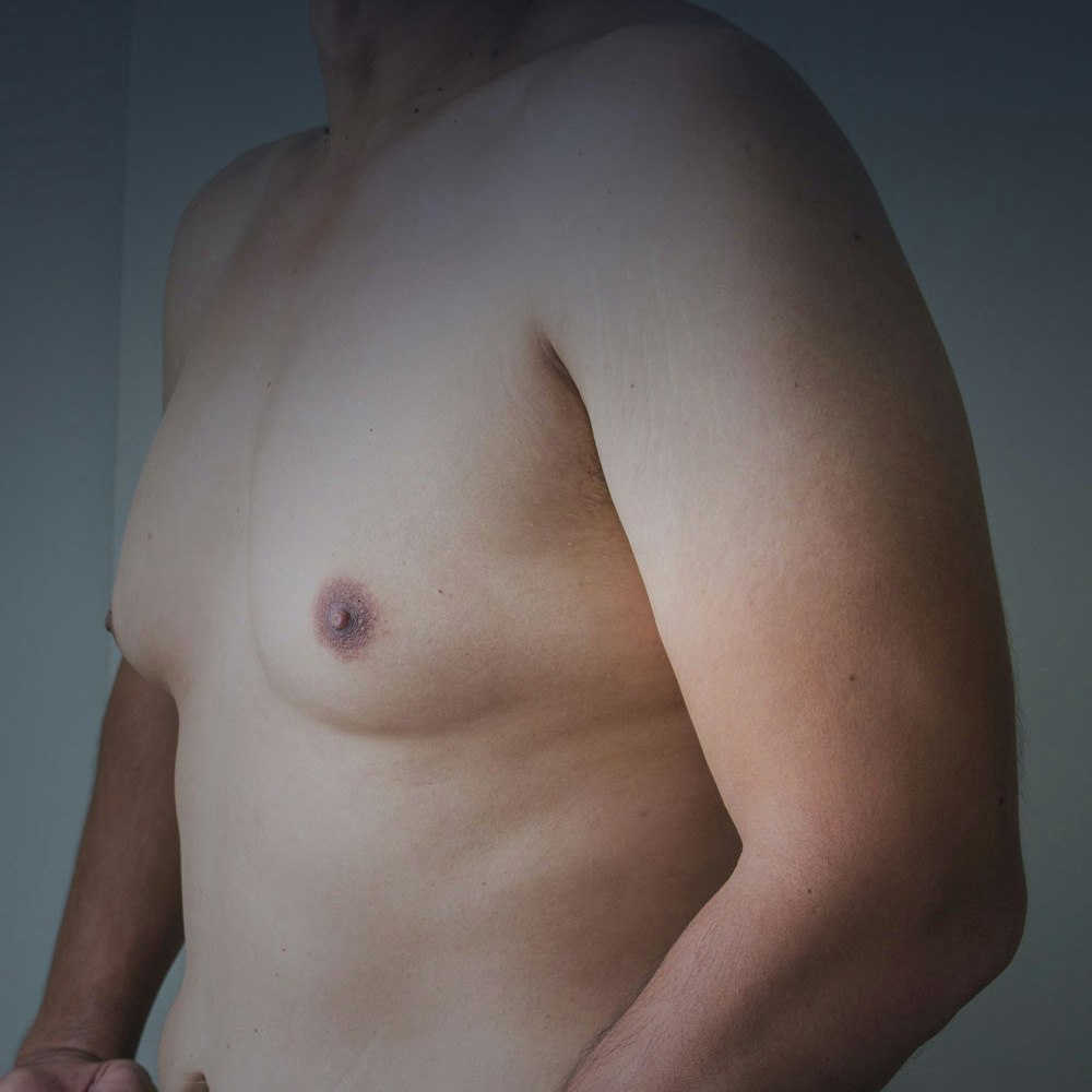 Chest of a man with gynecomastia