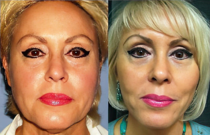 before and after facelift