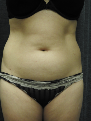 Dr. Constance Barone's patient before liposuction