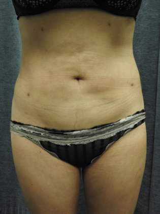 Dr. Constance Barone's patient after liposuction