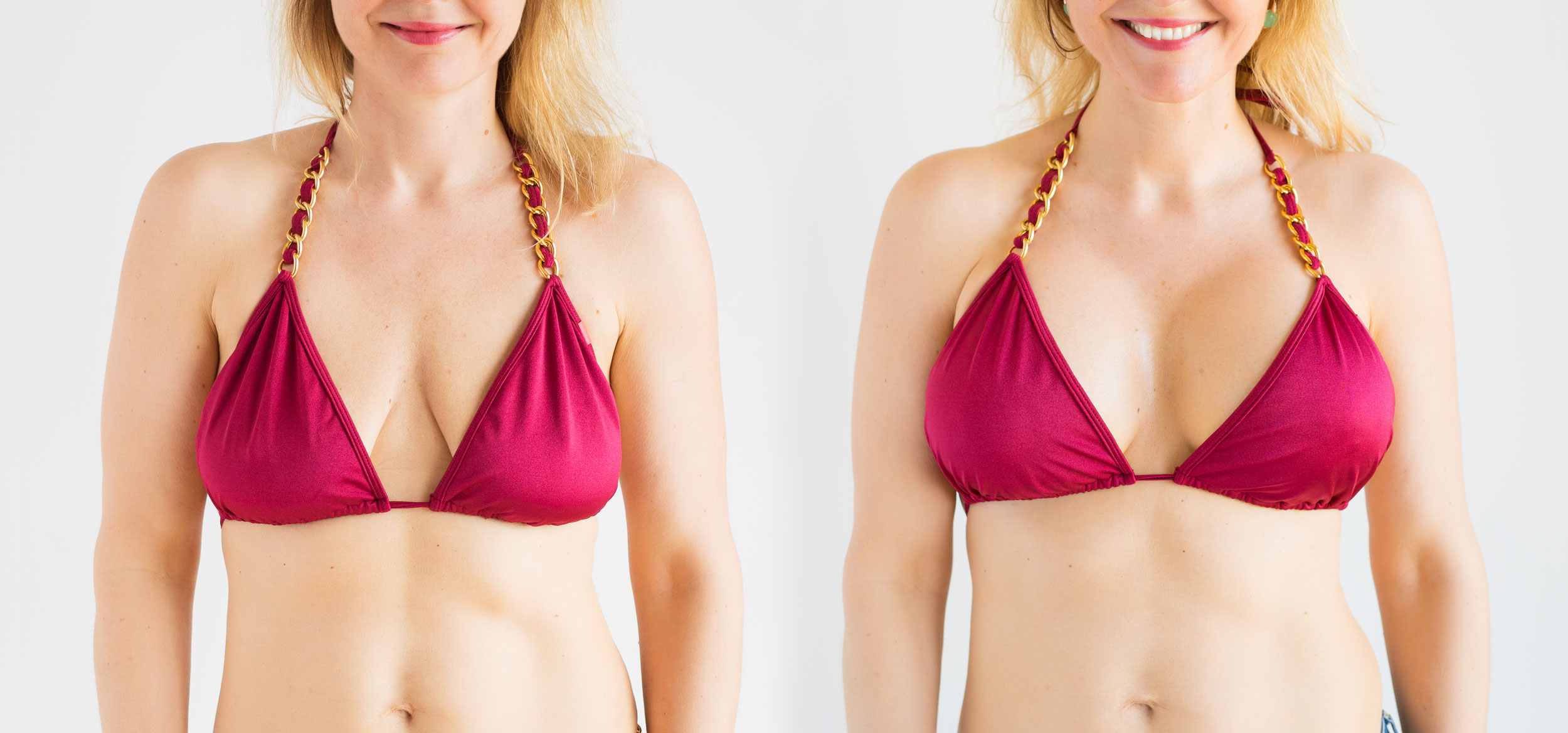 Patient before and after breast aug