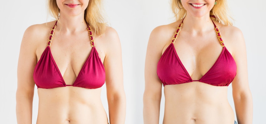 Patient before and after breast aug