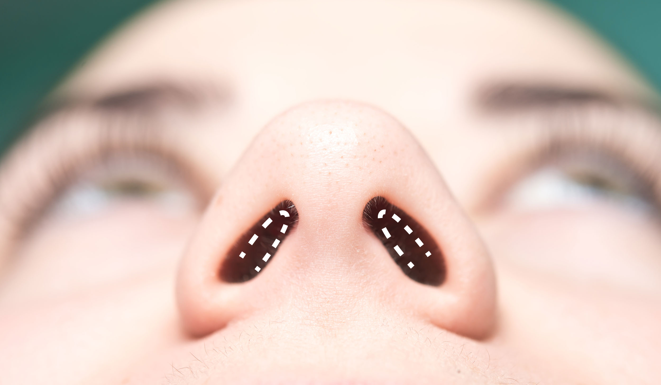 Closed Rhinoplasty