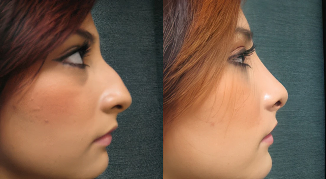 before and after rhinoplasty by Dr. Constance Barone