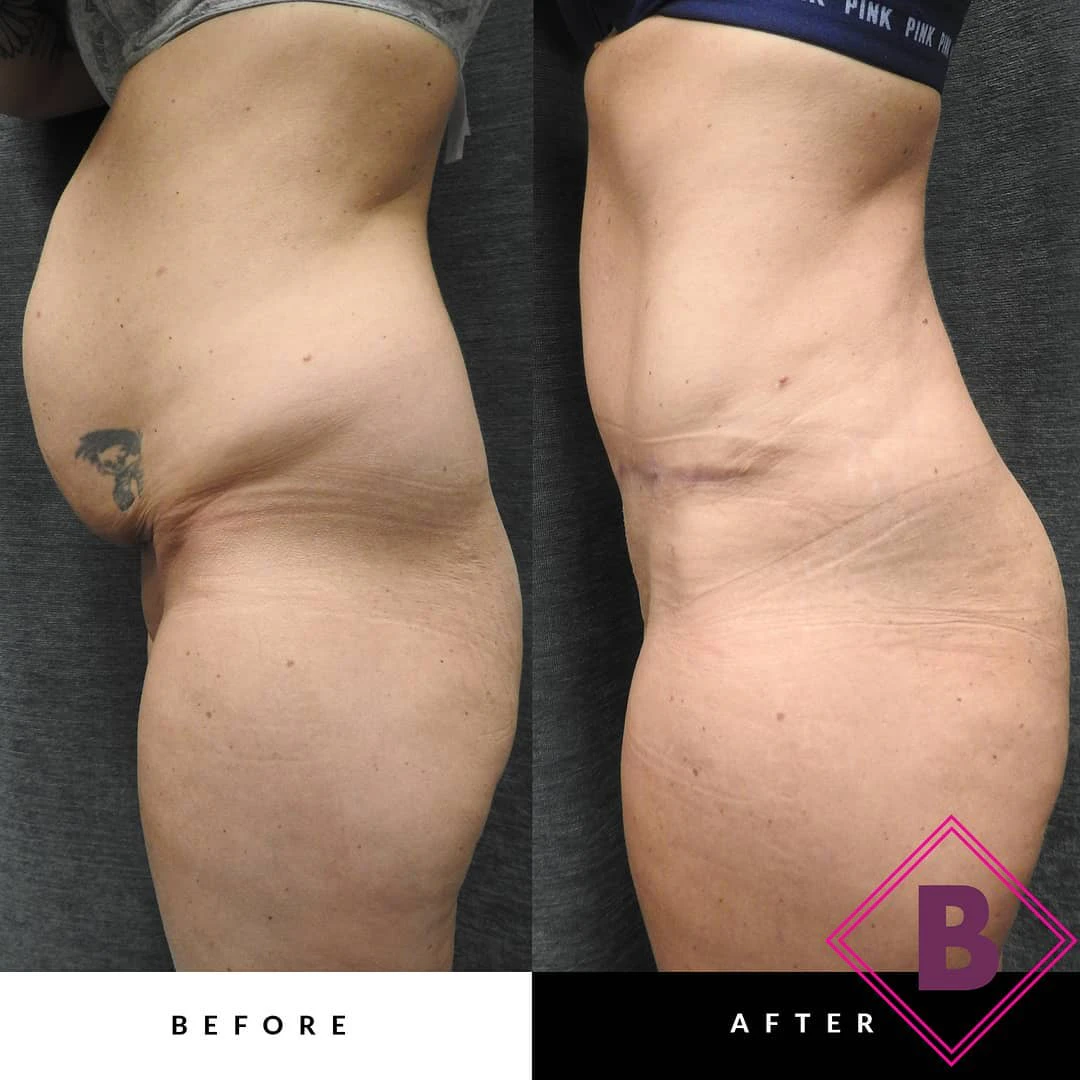 Before and After Tummy Tuck by Dr. Barone