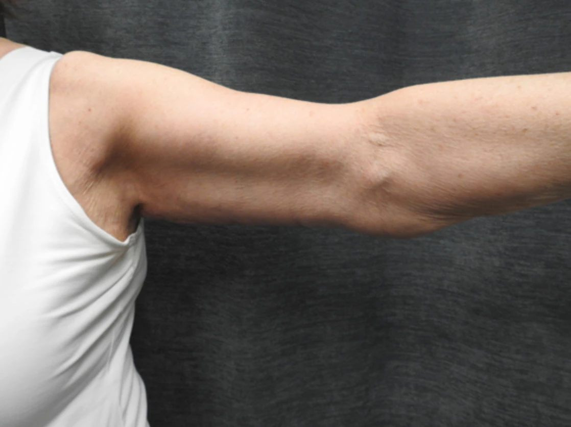Case 4 after arm lift