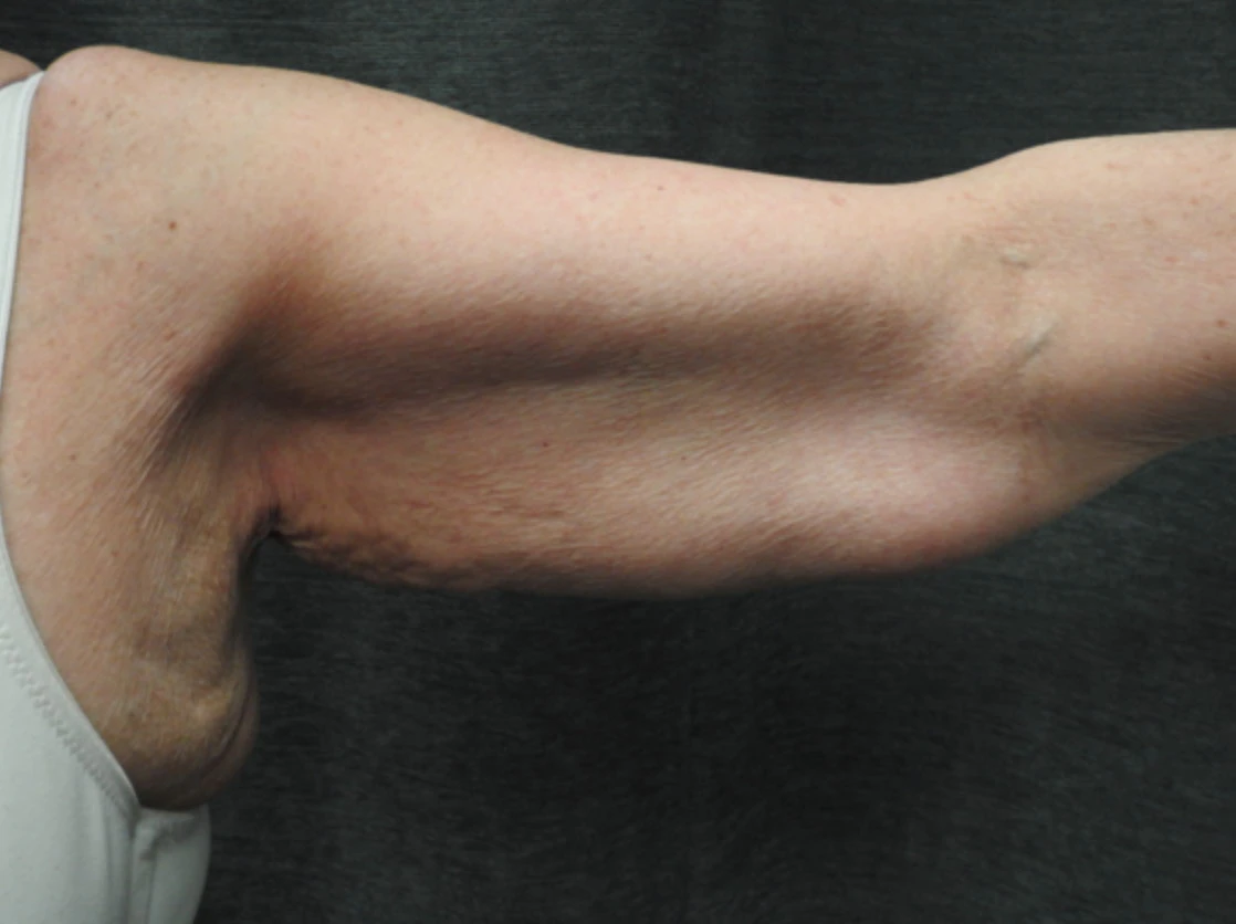 Case 4 before arm lift