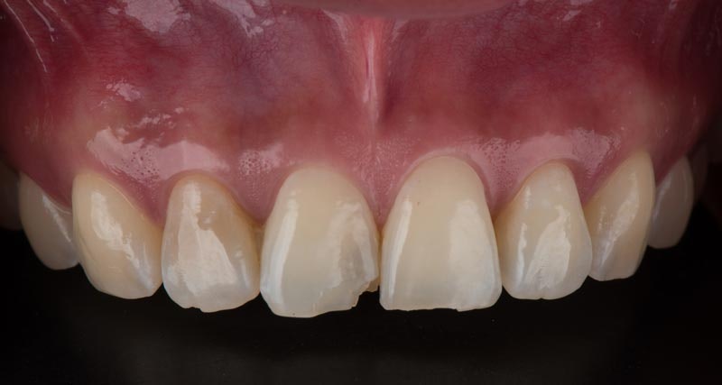 Discolored and broken teeth