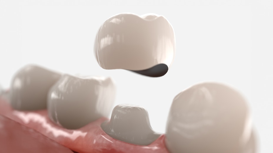 Dental crown being placed on a tooth