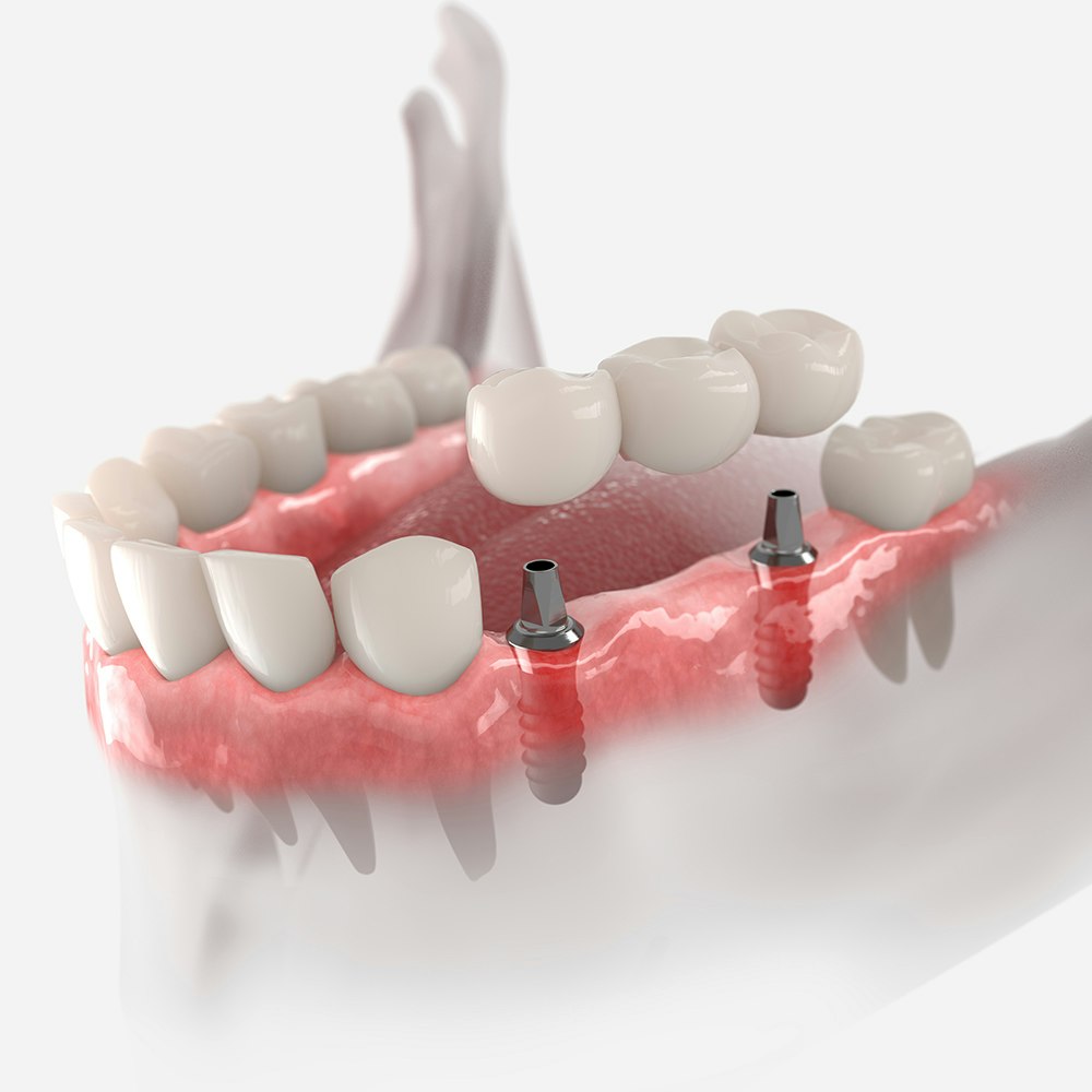 Implant-Supported Bridge