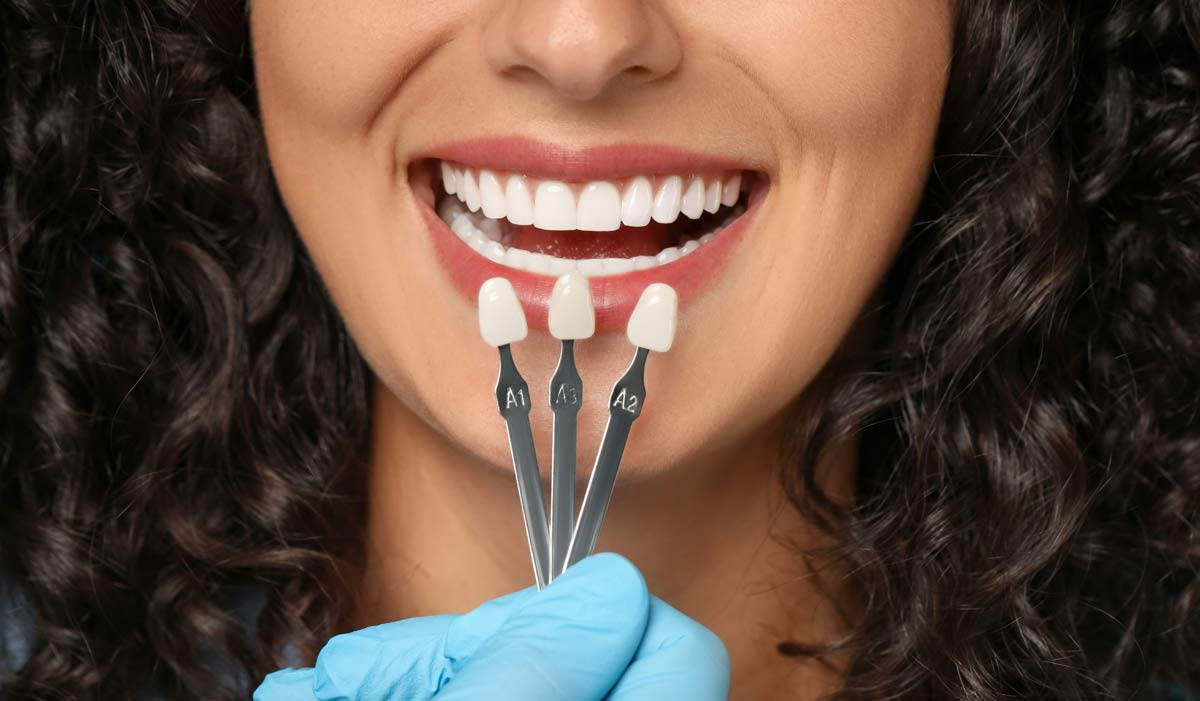 Veneer shade guides next to woman's teeth