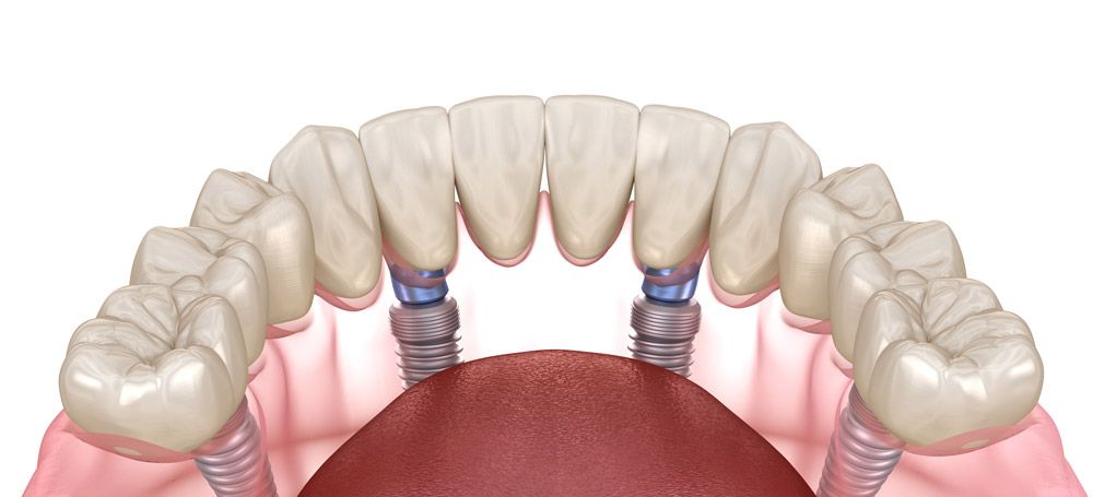 illustration of all-on-4 implant-supported dentures