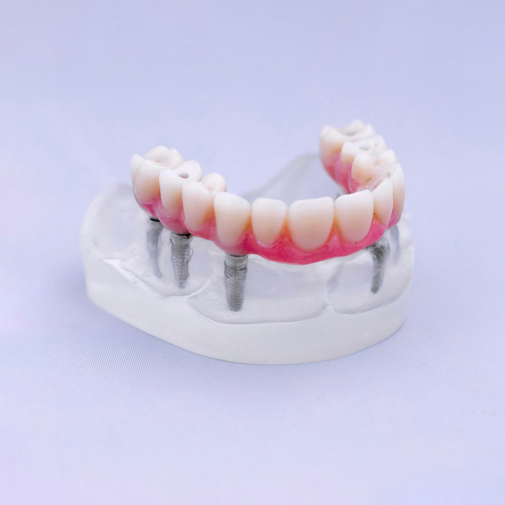 Dental implant denture