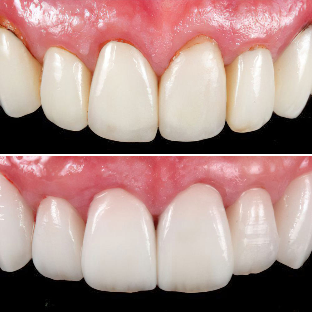 Dental Crowns Case 2 before and after