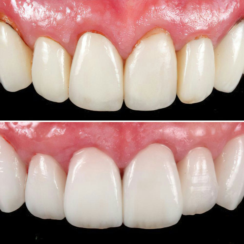 Dental Crowns Case 2 before and after